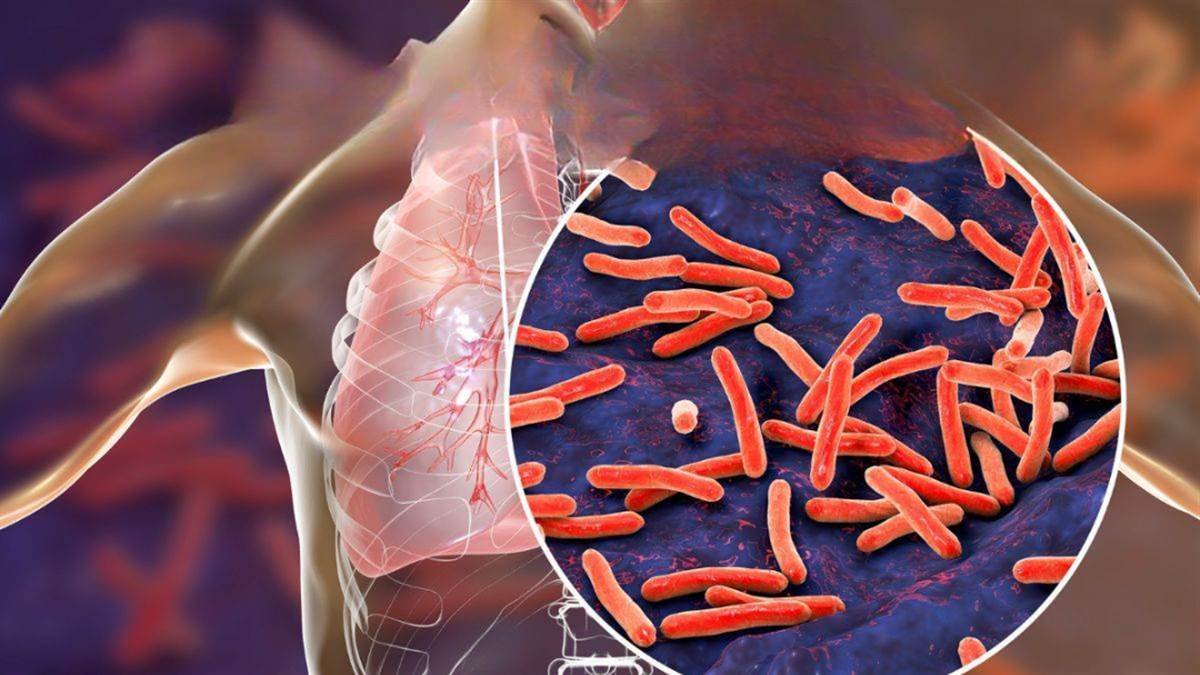 06_08_2026-tb_free_campaign_mp_tuberculosis.jpg